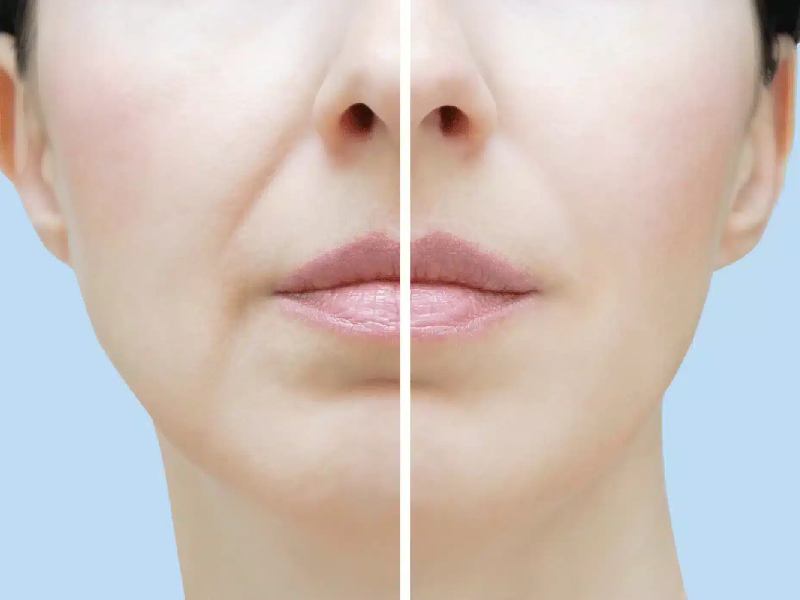 Nasolabial Fold Treatment